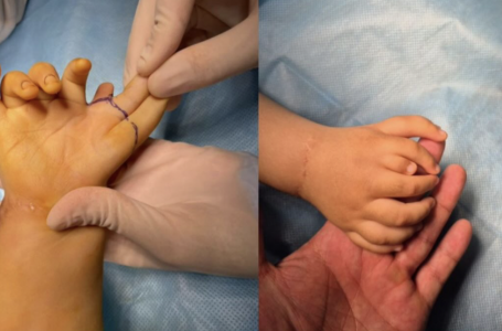 Сегіз саусақпен туған: Алматыда дәрігерлер бірегей ота жасады