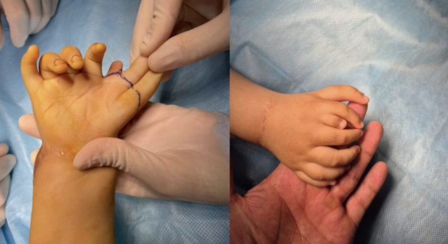 Сегіз саусақпен туған: Алматыда дәрігерлер бірегей ота жасады