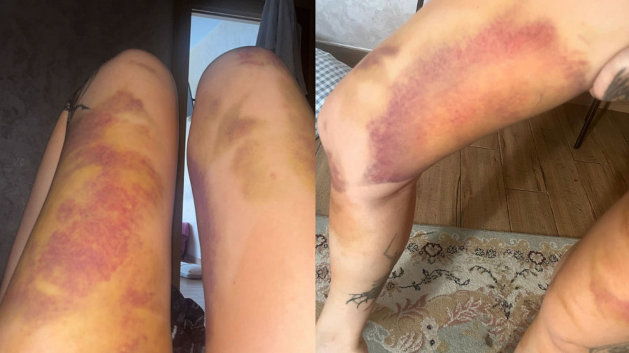 Күйеуім мені ұрды