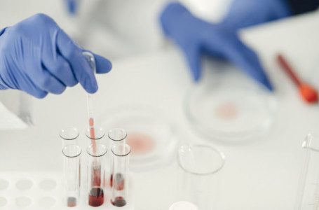 Ақмола облысында сегіз адам сібір жарасын жұқтырған