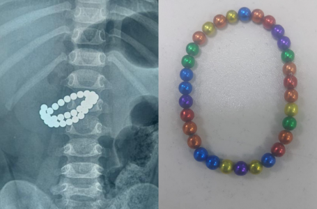 Алматыда бала 31 магнит жұтып қойған