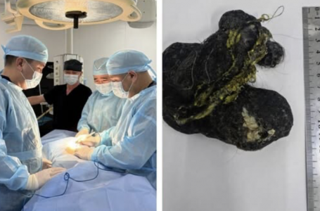 Шымкентте 8 жастағы баланың асқазанынан ірі көлемде шаш шықты