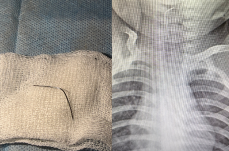 Түркістан облысында 9 айлық сәби ине жұтып қойған