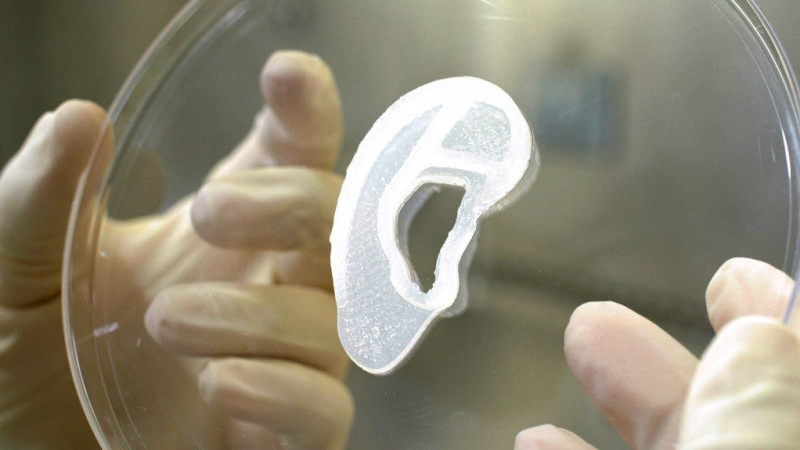 Науқасқа тұңғыш рет 3D принтерде басылған жасанды құлақ салынды 